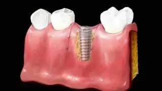EzCodi   Implant Treatment after Extraction