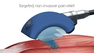 Myofacial Acoustic Compression Therapy