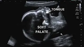 Ultrasound Pregnancy Palate (hard and soft palate) for cleft palate and cleft lips assessment.