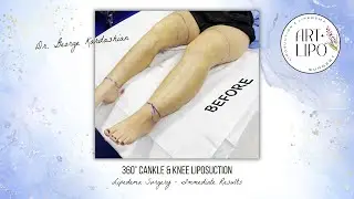 360&deg; Cankle & Knee Liposuction | Lipedema Surgery | Artlipo | Expert Dr. George Kardashian