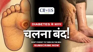 Diabetic Foot Deformity | Did you know | CIIVES | #video #diabeticfootcare #didyouknow