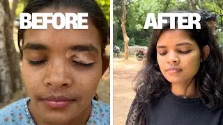 India&rsquo;s Best Vitiligo And Skin Disease Treatment Hospital Purulia ||सफेद दाग और चर्म रोग का सफल इलाज