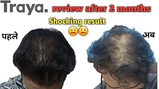 Traya hair treatment review after 2 months. Shocking result 😭😭