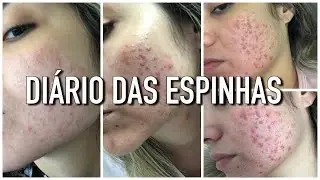 DIÁRIO DAS ESPINHAS - INÍCIO DO TRATAMENTO CONTRA ACNE