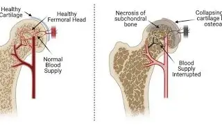 traumatic or non traumatic Avascular Necrosis; death of bone tissue due to disrupted blood supply