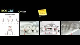 20130623-iAOI-Nonsurgical Treatment of Anterior Open Bite Malocclusion