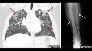 Understanding Fat Embolism Syndrome  A Comprehensive Guide for Orthopedic Surgeons.