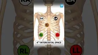 How to place a 5-lead 