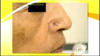 Dallas Dermatologist-PARKCITIES-2009-04-17-0.wmv