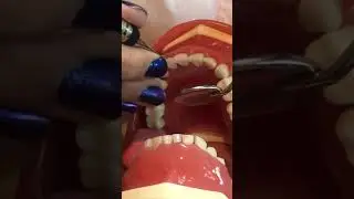 Anterior Gracey Lingual 9-11
