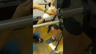 getting my new prosthesis started with a pin connector then changed to a strap connector