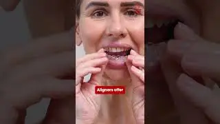 Braces vs Aligners: Which is Right for Your Smile? 😁