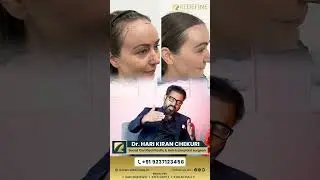 Women లో Receding Hairline కి ఉన్న Treatment Options ఇవే! | Hair Loss in Women | Telugu Health
