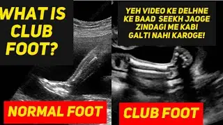 Club foot deformity ultrasound | how to diagnose | learn ultrasound | #radiology  #clubfoot #fetal