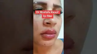 #botox #كيراتين #botoxfiller #beauty #تجميل #skincare #filler #lips #بوتوكس