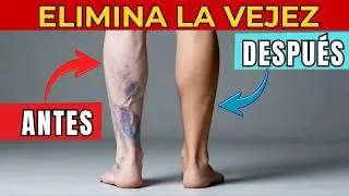 5 Claves M&eacute;dicas Para Evitar las Varices Desde Hoy | Consejos de Salud