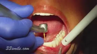 Cosmetic Dentistry Lower Prepless Veneers