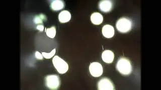 Pt. 1 Corneal Ulcer Onset- White Blood Cells Interacting w/ Reflection of Microscope