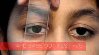 4PD AND 20PD BASE OUT TEST MONOFIXATOR WITH ACT