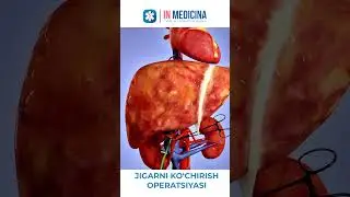 ЖИГАР КЎЧИРИШ ОПЕРАЦИЯСИ МАНА ШУНДАЙ БЎЛАДИ. #sirroz #inmedicina #jigar