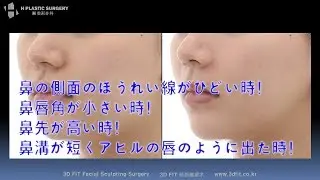 韓国整形外科, ほうれい線, アヒル唇, 鼻唇角陥没の患者のノーブルケット手術 貴族手術、猫手術の実例 [エイチ整形外科]