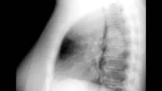 Thyroid Goiter on Chest X ray