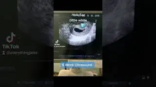 6 week Ultrasound