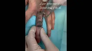 Laser tattoo removal #beforeafter  #tattooremoval #lasertattooremoval #olimpiacarmen