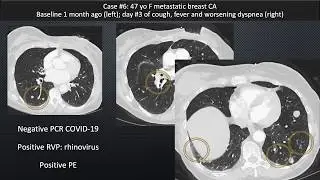 Pt. 1 Chest CT Appearance of COVID-19