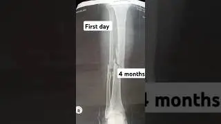 Bone fracture healing process