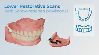 Restorative Full-Arch Protocol from Screw Retained Provisionals: Lower Arch Case