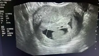 H&igrave;nh ảnh si&ecirc;u &acirc;m chửa trứng &hellip; c&oacute; k&egrave;m Chorionic Bump