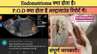 Endometrioma क्या है । p.o.d क्या होता है अल्ट्रासाउंड रिपोर्ट में।Shamita shetty endometriosis।