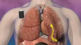 remedē&reg; System Implant Procedure
