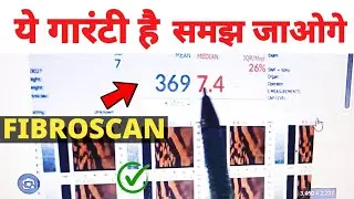 fibroscan test for liver | fibroscan report kaise dekhe | normal kpa score , cap score