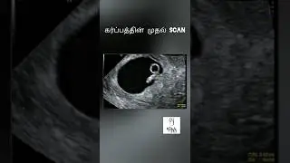 First scan in Pregenancy Tamil #MrsLife #shorts #pregenancy #scan