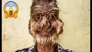 These Parents Were Left Distraught When Their Children All Developed Werewolf Syndrome