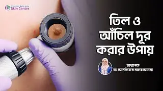 তিল রিমুভ করার উপায় | আঁচিল রিমুভ লেজার | Mole Removal Laser | Laser mole removal treatment