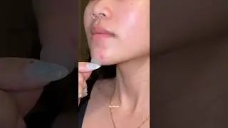 Это САМЫЕ УЖАСНЫЕ прыщи 😭 #pimplepatch #pimple