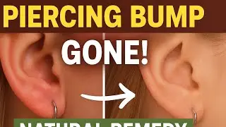 How to get rid of piercing bump naturally/easy home remedies.