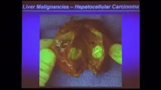 Update on Liver Cancer - Vatche G. Agopian, MD | UCLA Primary Care Update 2015