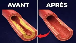 Le Meilleur Repas Pour Dilater les Artères et Réduire le Risque d’AVC (Preuves Scientifiques)