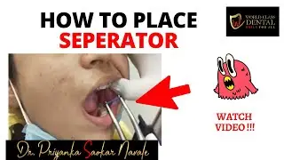 How to place Separators | World Class Dental | Dr Priyanka Saokar navale