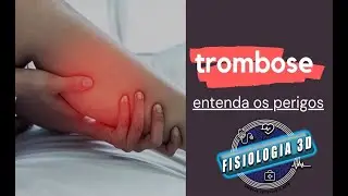 Trombose: Entenda os Sintomas e Como Ela Pode Amea&ccedil;ar Sua Sa&uacute;de