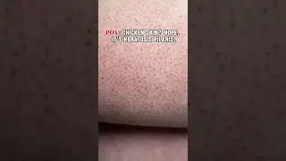 Chicken Skin? Nope, It&rsquo;s Keratosis Pilaris! | How to Treat It ✨
