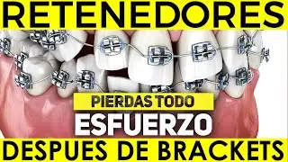 Cuánto TIEMPO se usan los RETENEDORES para EVITAR que los dientes se MUEVAN después de los BRACKETS