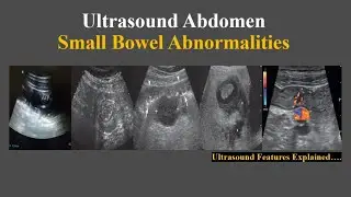 Ultrasound features of small bowel abnormalities || Radiology cases tutorial