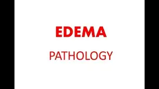 Edema  in hindi  for medical students   pathology lecture