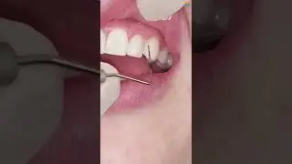 Mastering the Periodontal Probe Like a Pro! 🦷 #shorts #dental #health #trending