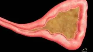 Symptomatic treatment for Sinusitis